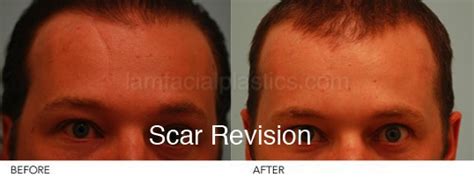 Scar Revision Dallas Reconstructive Plastic Surgery Plano Tx