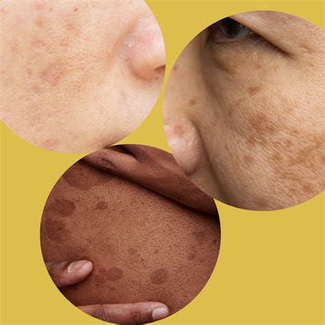 Inilah Perbedaan Flek Hitam Melasma Dan Hiperpigmentasi COLAGOLD