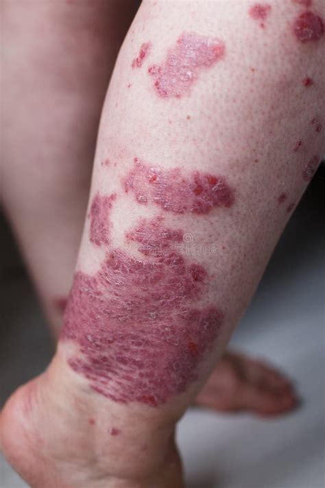 Allergic Rash Dermatitis Eczema Skin On Leg Of Patient Psoriasis And