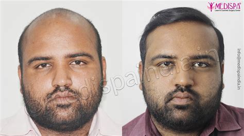 Best Hair Transplant Results Hair Transplant Dubai Cost