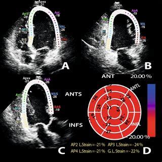 Left Ventricle Global Longitudinal Strain A Regional Strain Imaging In