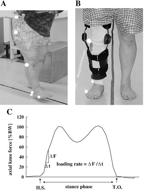 Figure From Knee Flexion Contracture Will Lead To Mechanical Overload