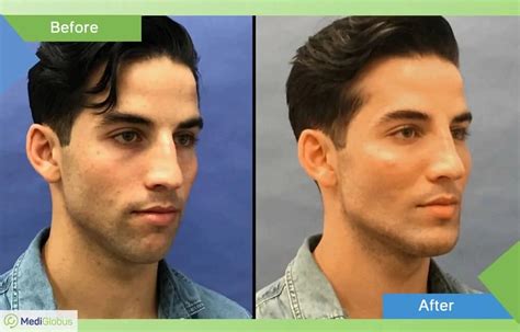 Male Facial Plastic Surgery Abroad Medical Tourism With Mediglobus