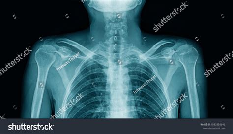 Xray Upper Part Human Body Stock Photo 1583358646 Shutterstock