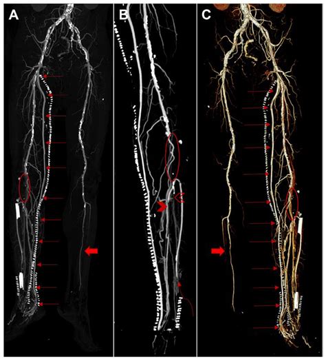 Conversion Of Femoral Tibial Bypass Surgery Into Deep Vein