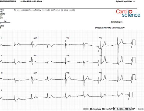 Ecg Ritmo Sinusal Arritmias Del Nodo Sinusal Cardio Science