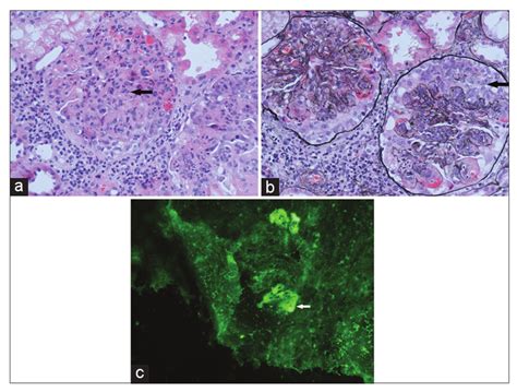 Development Of Crescentic Immunoglobulin A Nephritis And Multiple Autoantibodies In A Patient