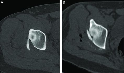 Preoperative A And Immediate Post Operative B CT Scans Illustrating