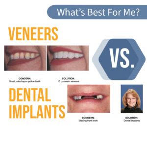 Veneers vs. Dental Implants: What is Best for Me? - Freeman Smiles ...