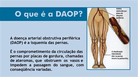 Doença Arterial Obstrutiva Periférica Daop Youtube