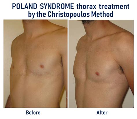 Poland Syndrome Thorax Treatment By The Dr Christopoulos Method