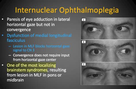 6 Neuro Ophthalmic Disorders And Disequilibrium Flashcards Quizlet