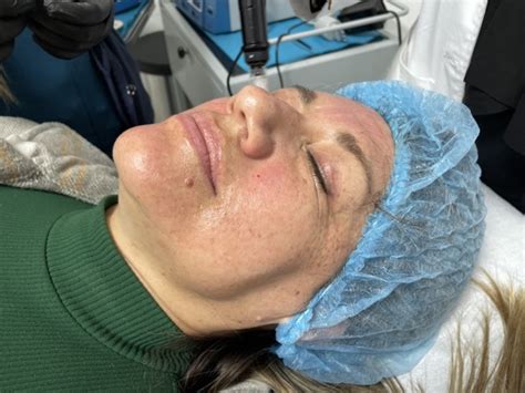 Mesoterapia Rejuvenecimiento Facial Médicos Especialistas