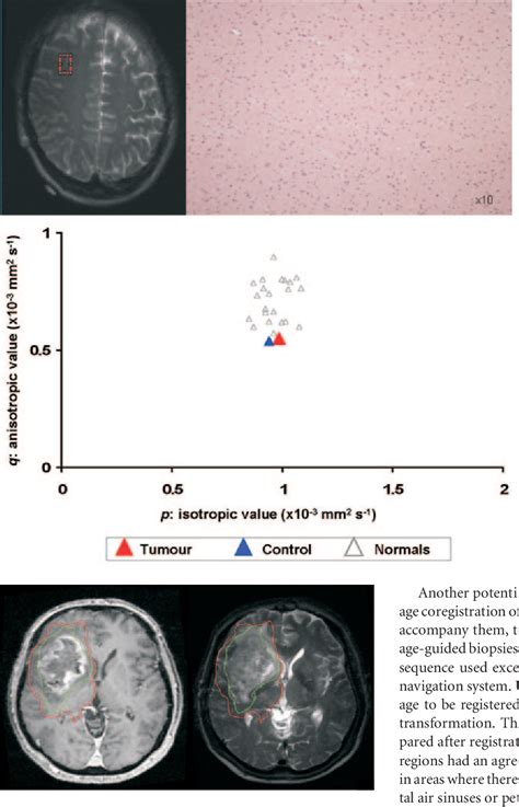 Figure 4 From Improved Delineation Of Glioma Margins And Regions Of