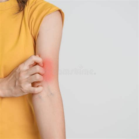 Woman Itching And Scratching Itchy Arm Sensitive Skin Allergic