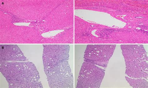 Histology. A: Pathological staining of the resected liver cancer tissue ...