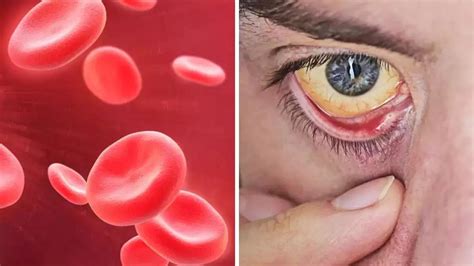 Hemoglobin की कमी होने पर शरीर देते हैं ये सिग्नल, लक्षण जानकर करें उपचार