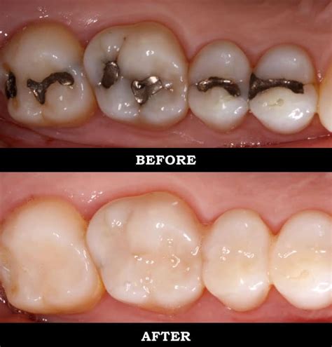 Amalgam Silver Vs Composite Resin White Fillings Allen Dental