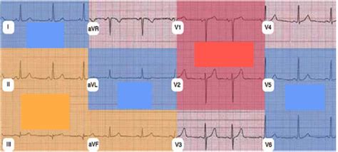 Clinical Risk Factors for Ischaemic Heart Disease Diagram | Quizlet