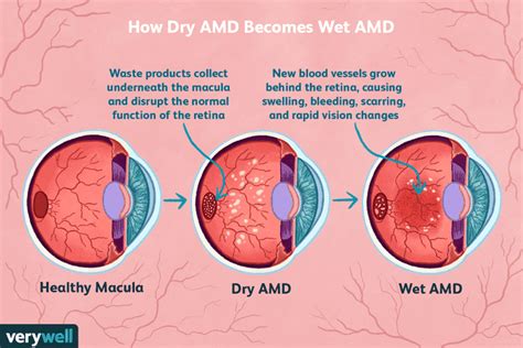 Macular Degeneration Breakthroughs Emerging Treatments New Research