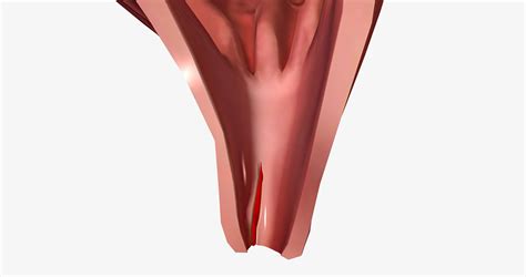 Absceso anal y fístula Dr Adolfo Rivas Cajina