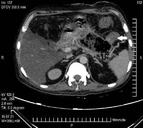 Pancreatico Colonic Fistula Cect Section Reveals A Large Acute