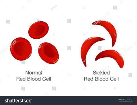 Sickle Cell Stock Vectors Images Vector Art Shutterstock