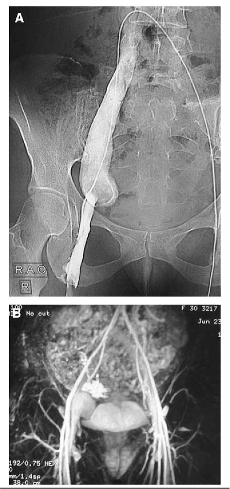 Figure From External Iliac Venous Aneurysm Treated With Tangential