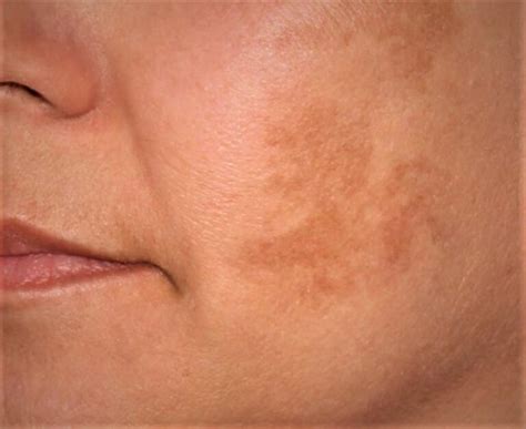 Come Si Cura Il Melasma Microbiologia Italia