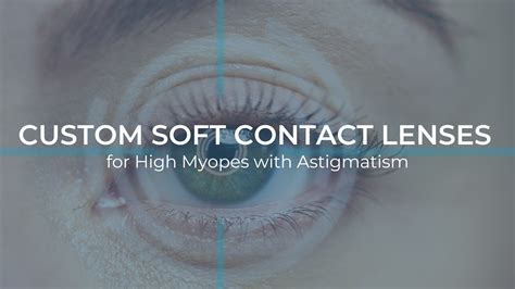 Custom Soft Contact Lenses for High Myopes with Astigmatism