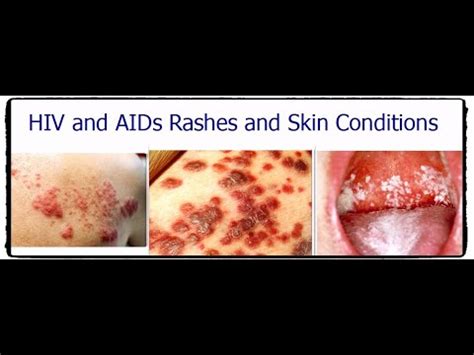 HIV and AIDS Rashes and Skin Conditions الطفح الجلدي بسبب فيروس نقص