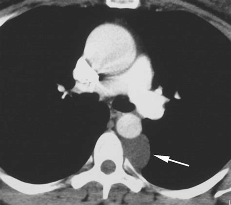 Imaging Of Cystic Masses Of The Mediastinum Radiographics