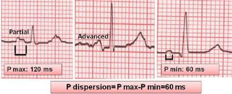 An example of measurement of P wave maximum, P wave minimum, and P wave ...