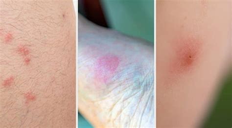 Mosquitoes Bites Vs Bed Bug Bites