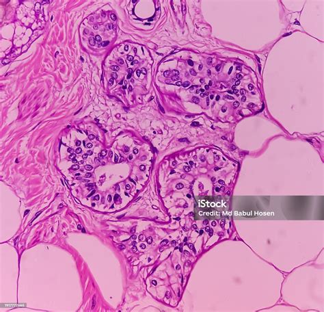 Mature Cystic Teratoma Ovarian Cyst Biopsy Show Cyst Wall Of Skin And