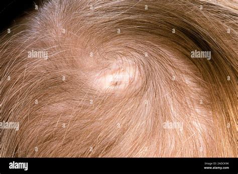 Scalp Of A 2 Year Old Female Patient With Aplasia Cutis Congenita Acc