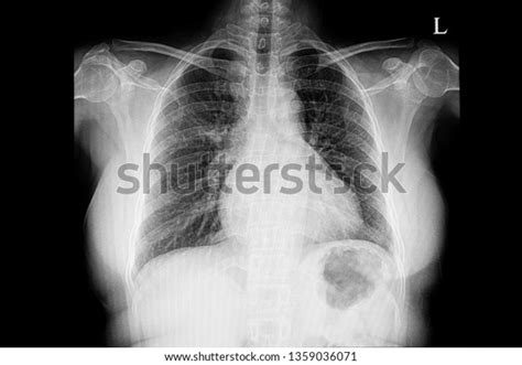 Chest Xray Film Patient Mild Cardiomegaly Stock Photo 1359036071