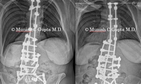 Revision Anteriorposterior Surgery With Pso Female Munish C Gupta Md