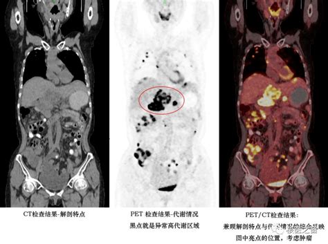 医生，我需要做petct吗？检查肿瘤患者