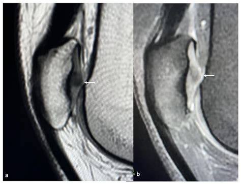 Life Free Full Text Imaging Of Cartilage And Chondral Defects An