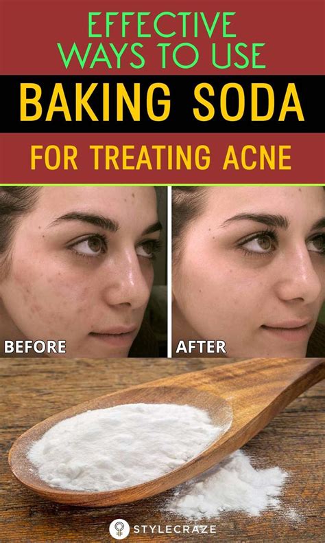 Baking Soda For Acne Effectiveness How To Use It And Risks Baking