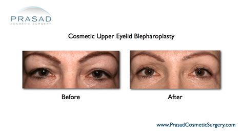 Eyelid Surgery | Upper Eyelid Surgery Procedure and Recovery - NY