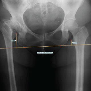 Pre A And Postoperative B Radiographs For Case Preoperatively