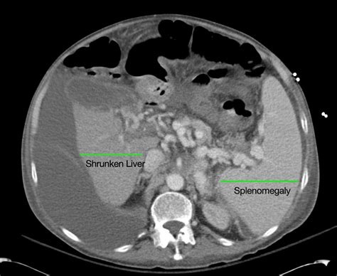 Cirrhosis Tags Differential Diagnosis Of