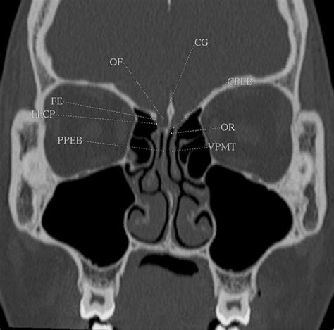 The Different Anatomical Structures Of The Ethmoid Roof Cg Crista