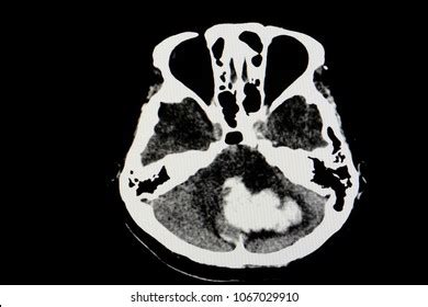 Ct Brain Scan Stroke Patient Massive Stock Photo Shutterstock