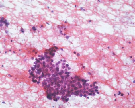 Hepatoblastoma - Eurocytology