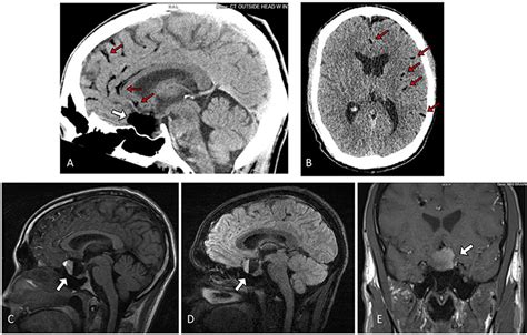 Frontiers Ruptured Suprasellar Dermoid Cyst Treated With Lumbar Drain