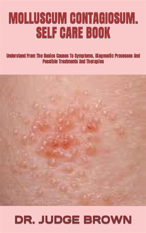 Molluscum Contagiosum Self Care Book Understand From The Basics