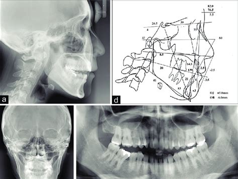 Pretreatment Radiographs And Tracing 22 Years 5 Months A Lateral